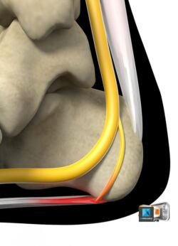 Irritation d'un nerf en 3D