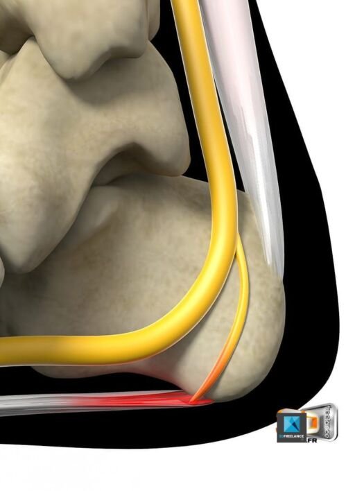 Irritation d'un nerf en 3D