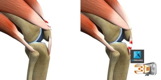 Déchirure Musculaire en 3D