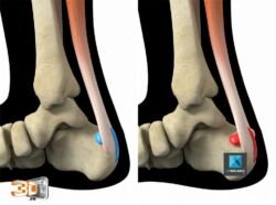 Irritation du tendon d'Achille