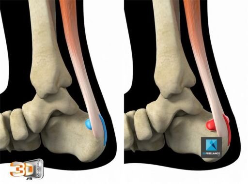 Irritation du tendon d'Achille