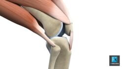 déchirure du tendon genoux - illustration médicale