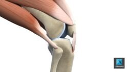 déchirure du tendon genoux - illustration médicale