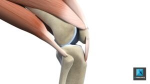 déchirure du tendon genoux - illustration médicale