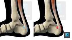 tendon d’Achille - illustration médicale