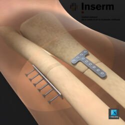 dessin schéma médical - soudure de l'os