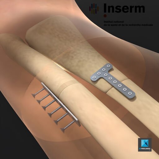 dessin schéma médical - soudure de l'os